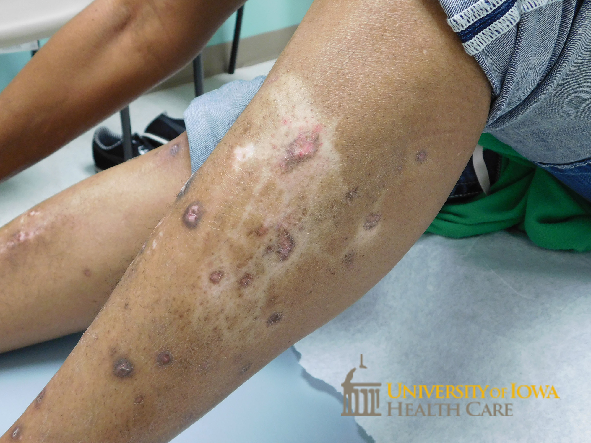 Violaceous to pink papules and plaques with surrounding hypopigmented patches. (click images for higher resolution).